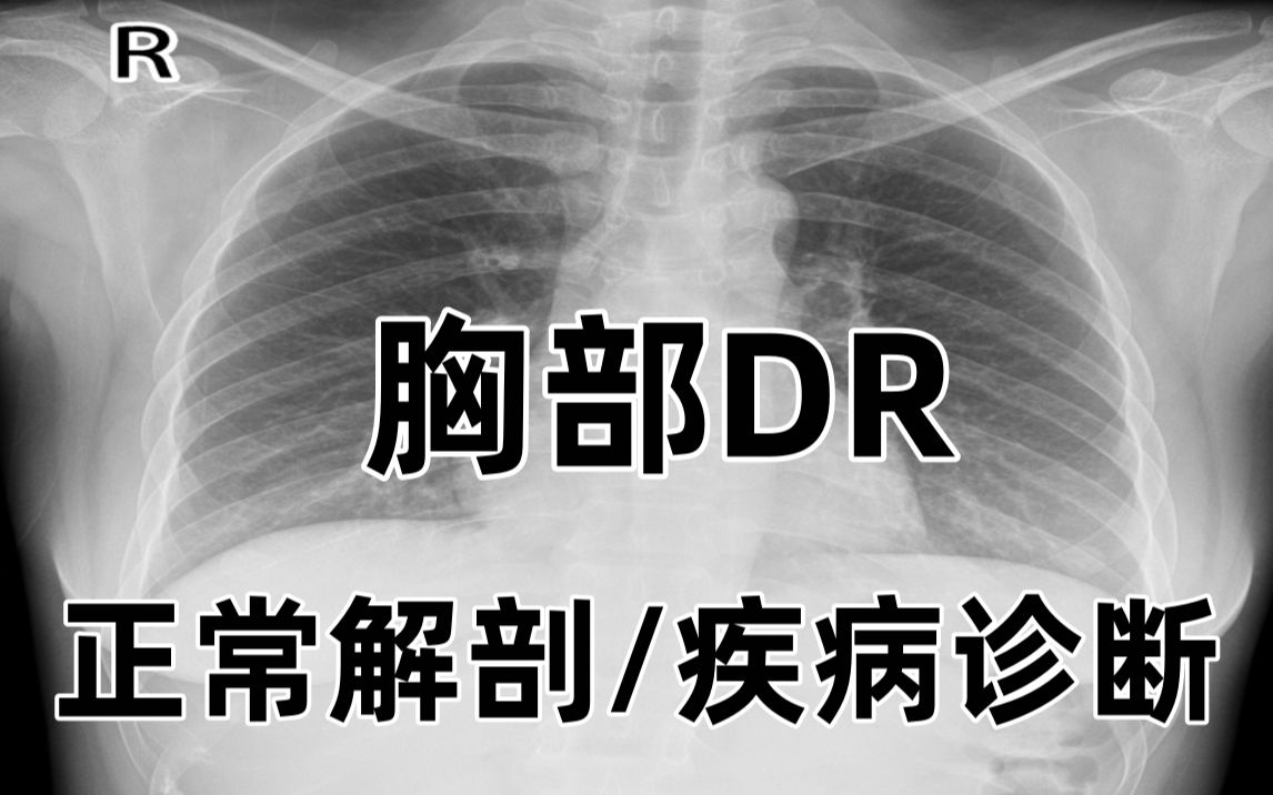 胸部DR疾病诊断+正常解剖_哔哩哔哩_bilibili